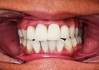 After cosmetic dentistry treatments at TRUST dental