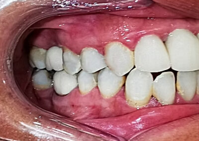 A close up showing an after of cosmetic dentistry