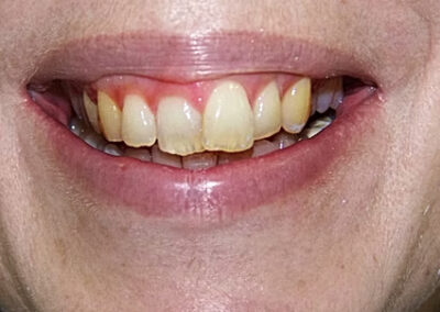 A set of teeth before cosmetic dentistry treatments at TRUST dental