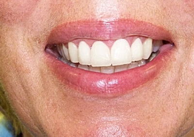 A set of teeth after cosmetic dentistry treatments at TRUST dental