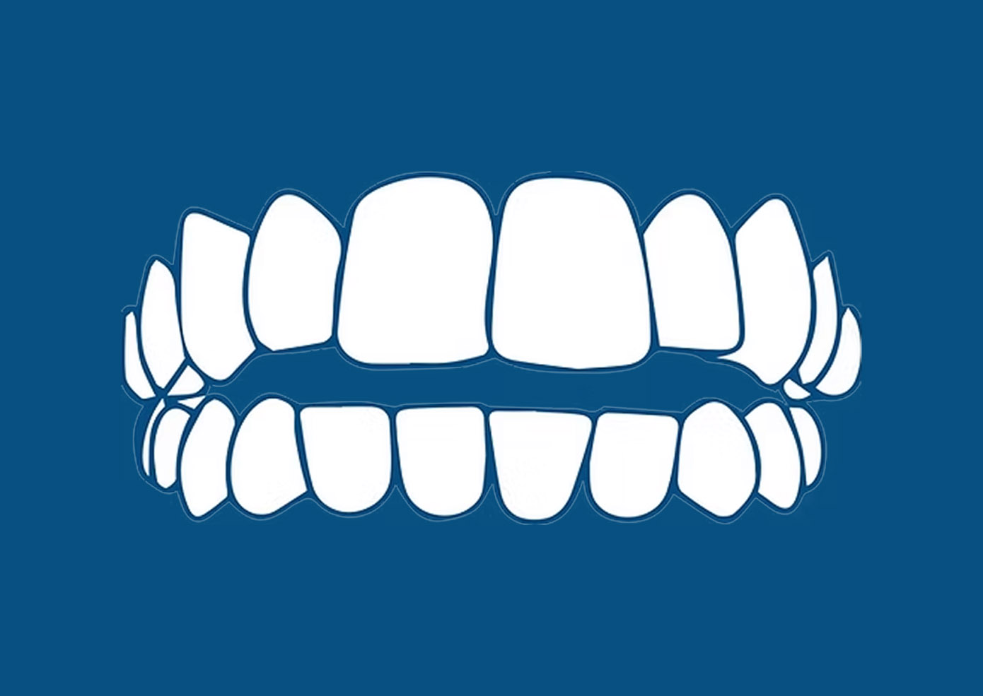 Orthodonic Aligners - TD Trust dental before and after teeth whitening