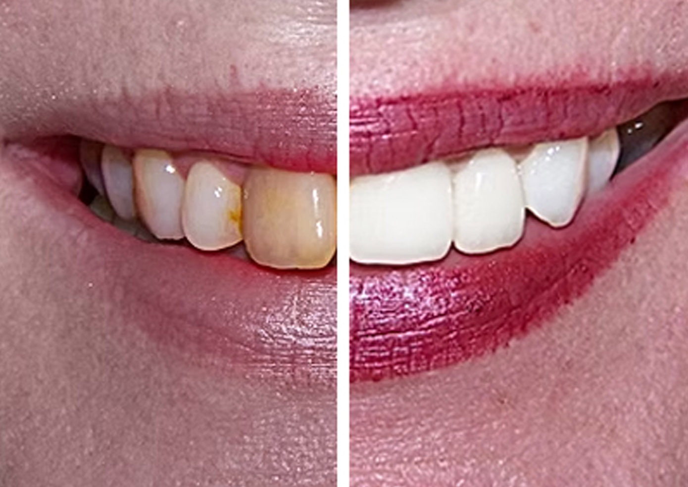 TD - Teeth Whitening Trust dental before and after teeth whitening