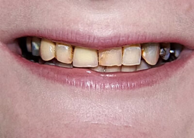 A set of teeth before teeth whitening treatments at TRUST dental