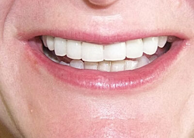 A set of teeth after teeth whitening treatments at TRUST dental