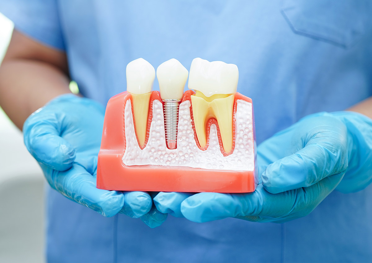 Dental Implants - TRUST Dental Dentist showing a model of dental implants