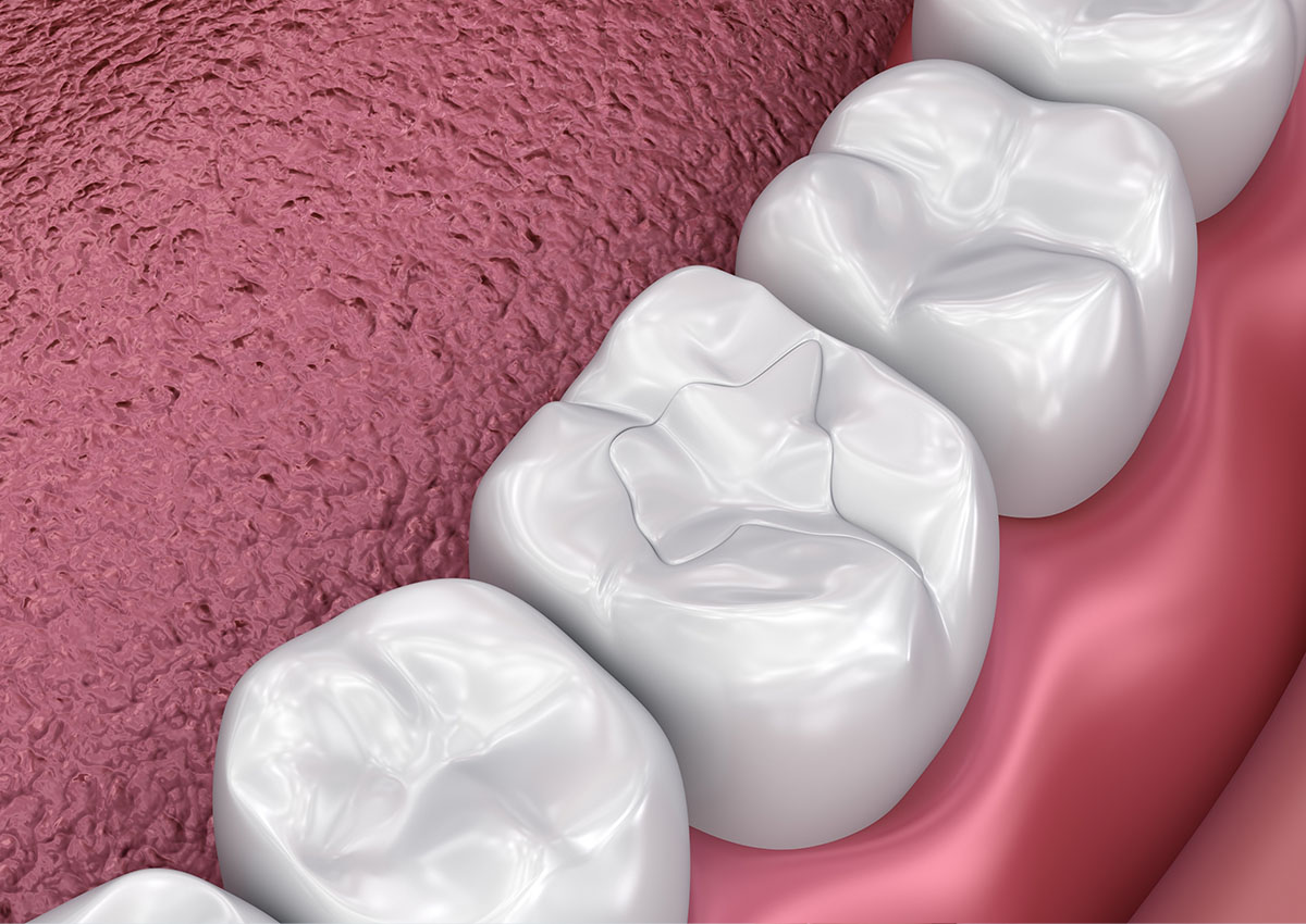 Fillings - TRUST Dental A dental diagram showing a white filling