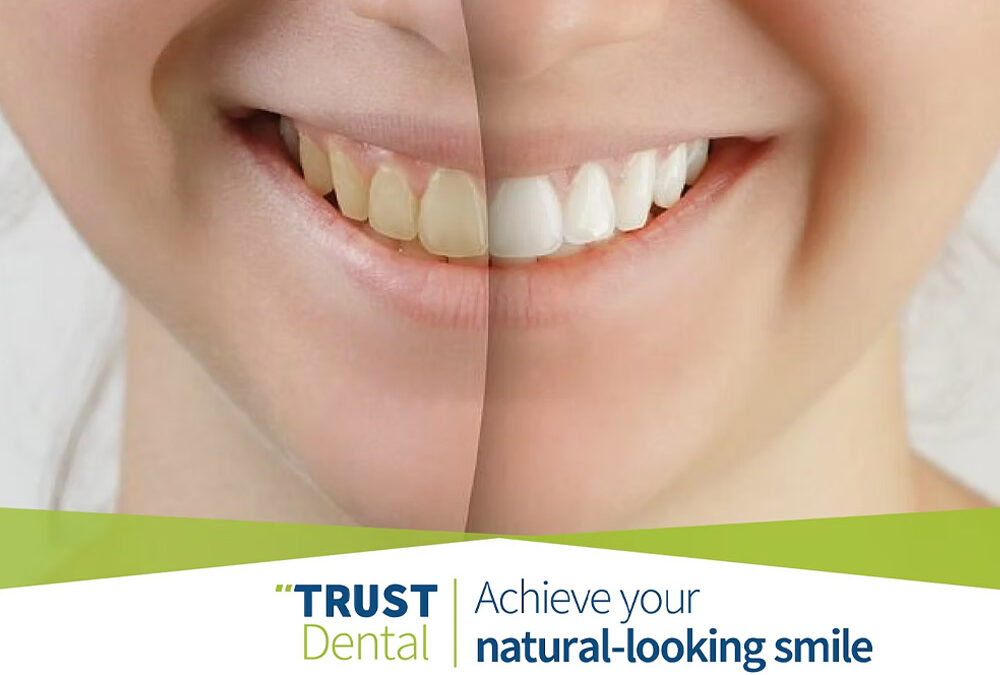 How to achieve your natural-looking smile