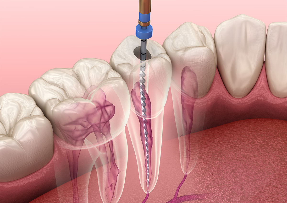 Root Filling - TRUST Dental A dentistry diagram showing a root filling treatment
