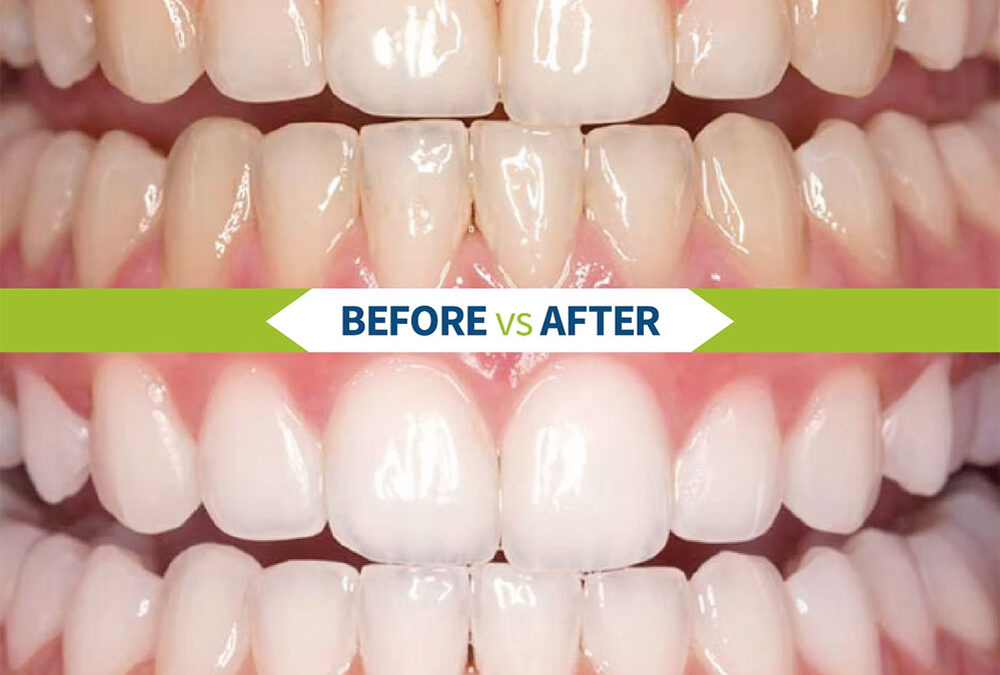 Thinking about a brighter, whiter smile?